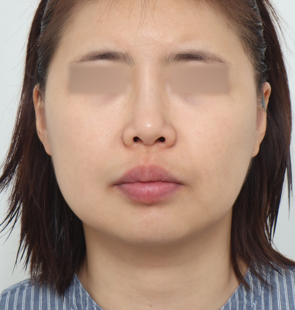 [중하안면 미니거상 + 심부볼지방재배치] 전
