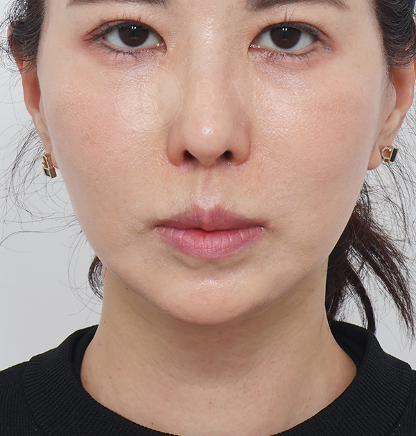[중하안면 미니거상 + 목거상 + 이중턱 근육묶기] 후