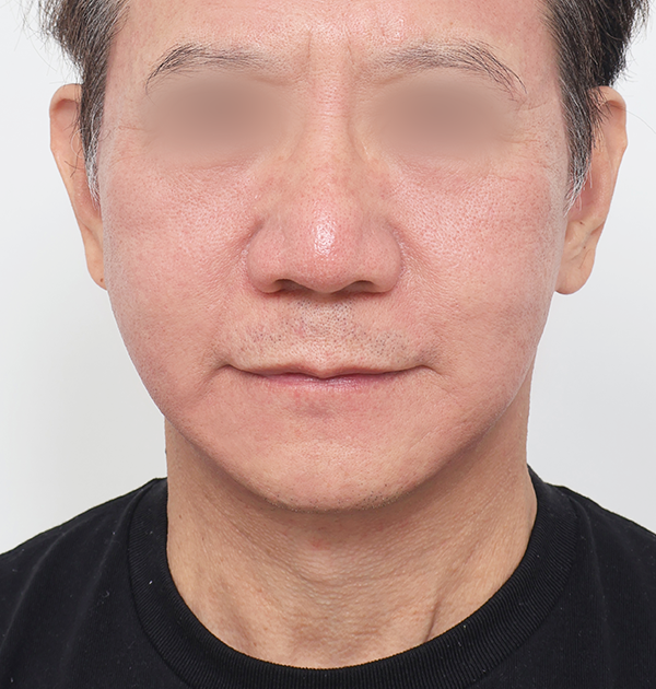 [남자 안면거상 + 목거상 + 심부볼지방재배치] 후