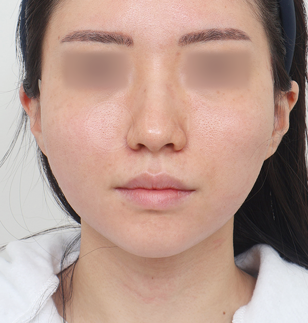 [민트실리프팅] 후