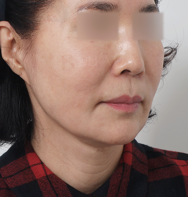 [딥플레인 안면거상 + 목거상 + 심부볼지방재배치 + 얼굴지방흡입 + 칼귀교정 + 이물질제거] 전