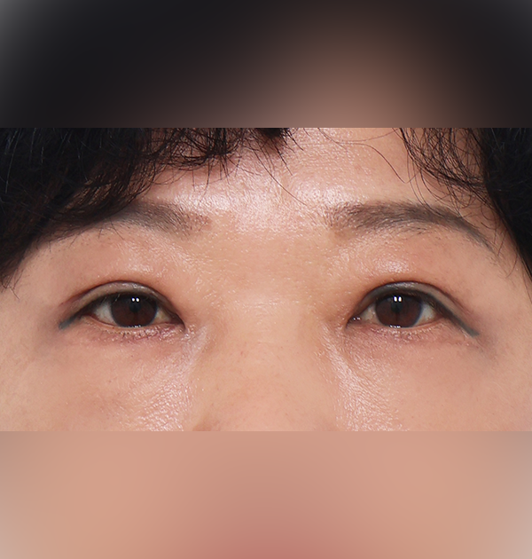 [상안검(재수술) + 하안검 + 눈매교정] 후