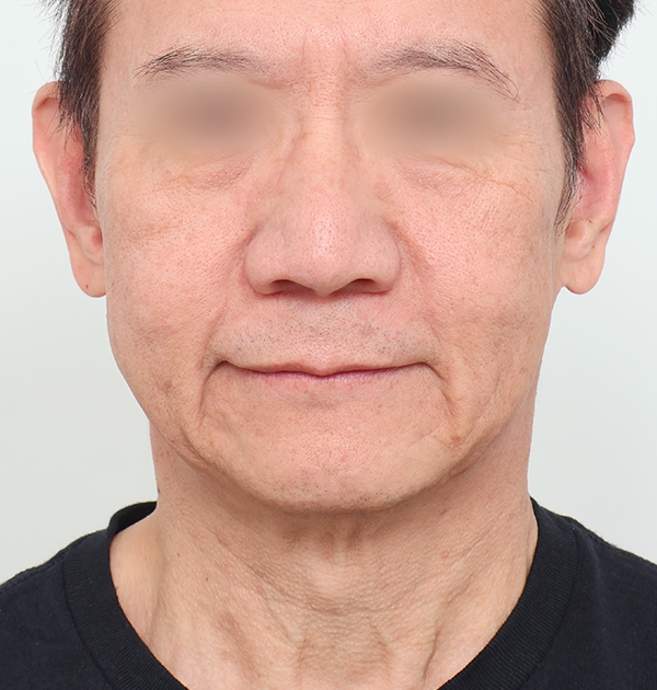 [남자 안면거상 + 목거상 + 심부볼지방재배치] 전