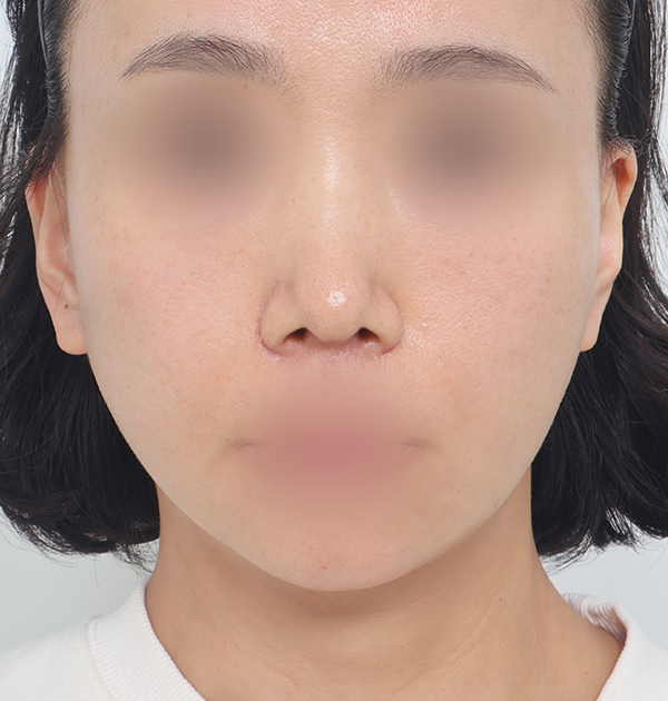 [중하안면 미니거상 + 심부볼지방재배치 + 지방이식] 후