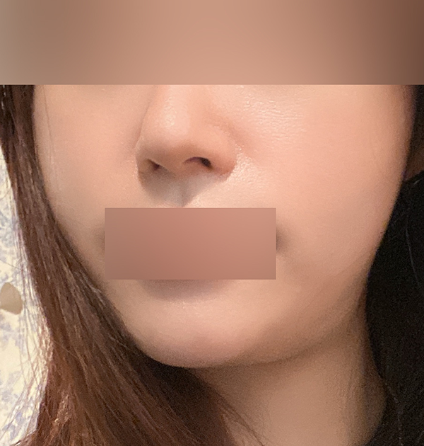 [이중턱지방흡입 + 근육묶기 + 양볼지방흡입] 전