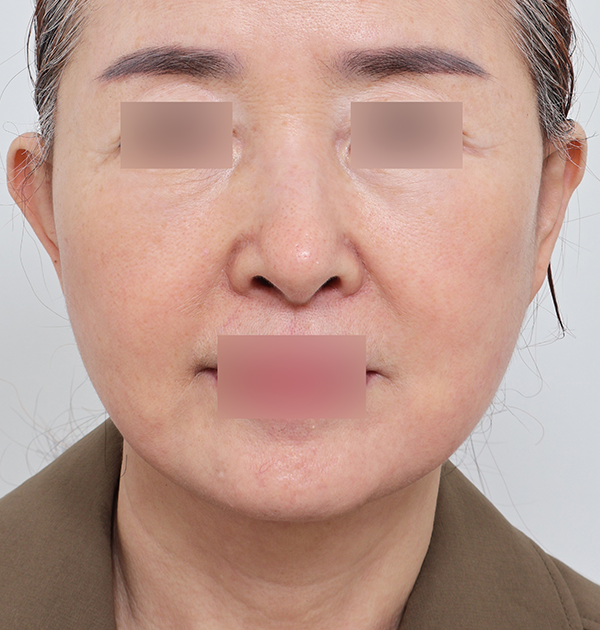 [안면거상 + 얼굴지방재배치] 후