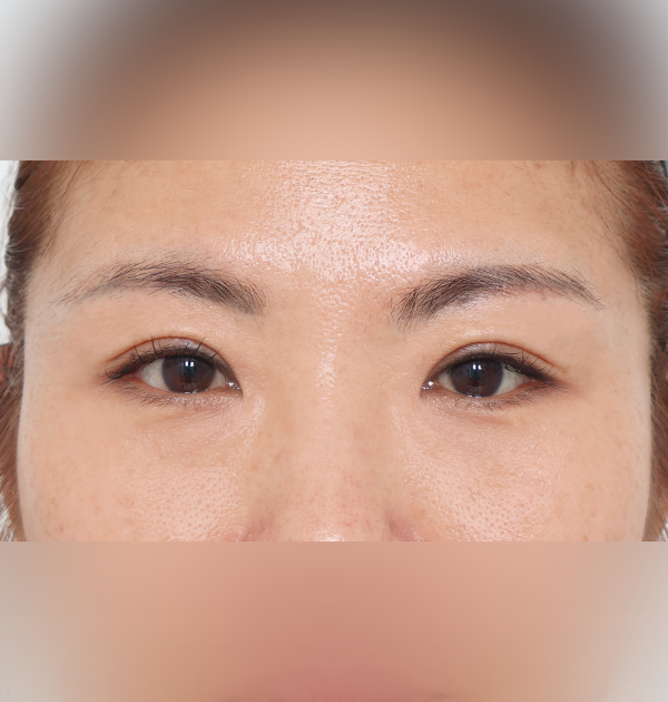 [상안검 + 눈매교정 + 윗트임] 후