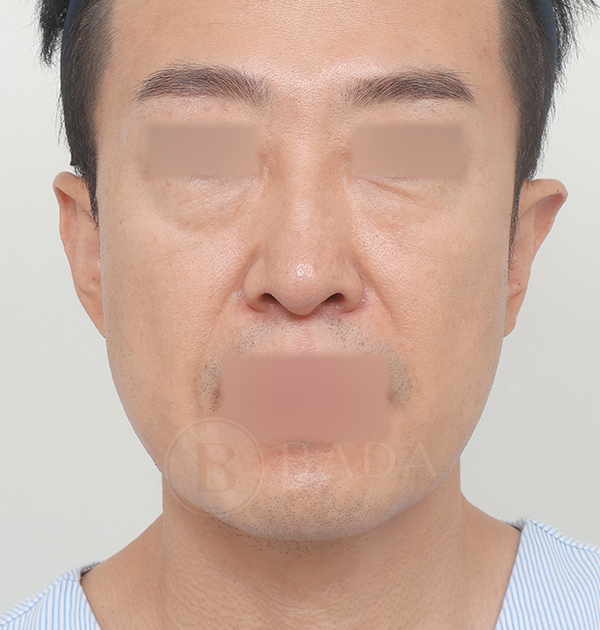 [남자 중하안면 미니거상 + 하안검 지방재배치] 전
