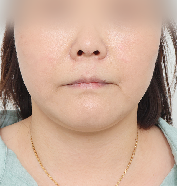 [안면거상 + 목거상 + 얼굴지방재배치] 후