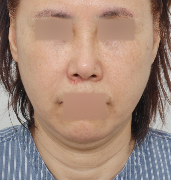 [딥플레인 안면거상 + 목거상 + 얼굴지방재배치] 전