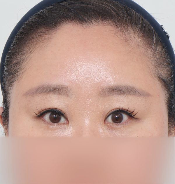 [이마거상 + 이물질제거] 후