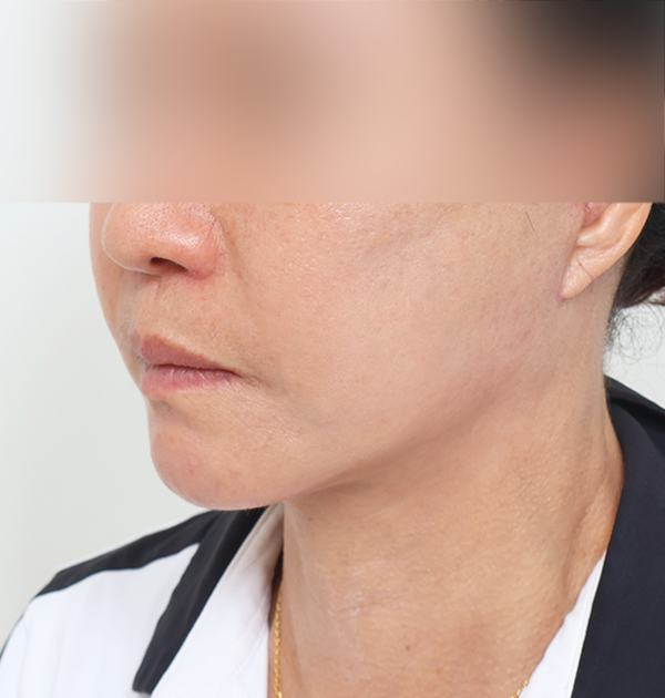 [안면거상 재수술 + 목거상 + 얼굴지방재배치] 후