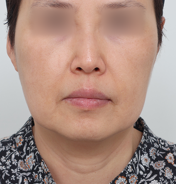 [딥플레인 안면거상 + 목거상] 전