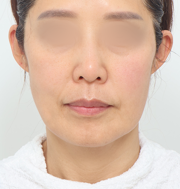 [중하안면 미니거상 + 얼굴지방재배치] 전