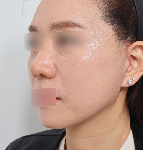 [중하안면 미니거상 + 얼굴지방재배치] 후