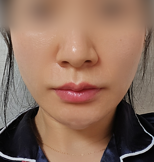 [민트실리프팅 + 스킨보톡스] 후