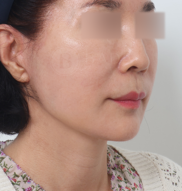 [딥플레인 안면거상 + 목거상 + 심부볼지방재배치 + 얼굴지방흡입 + 칼귀교정 + 이물질제거] 후