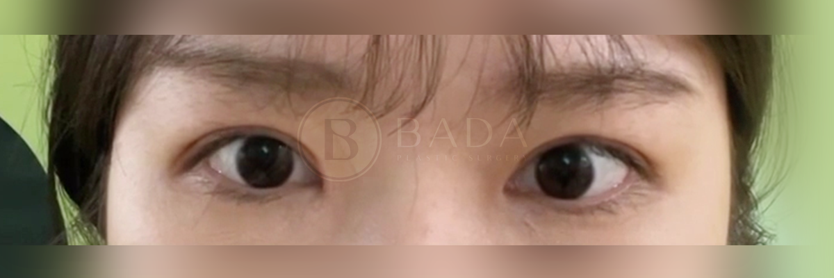 [절개 + 눈매교정 + 앞트임] 후