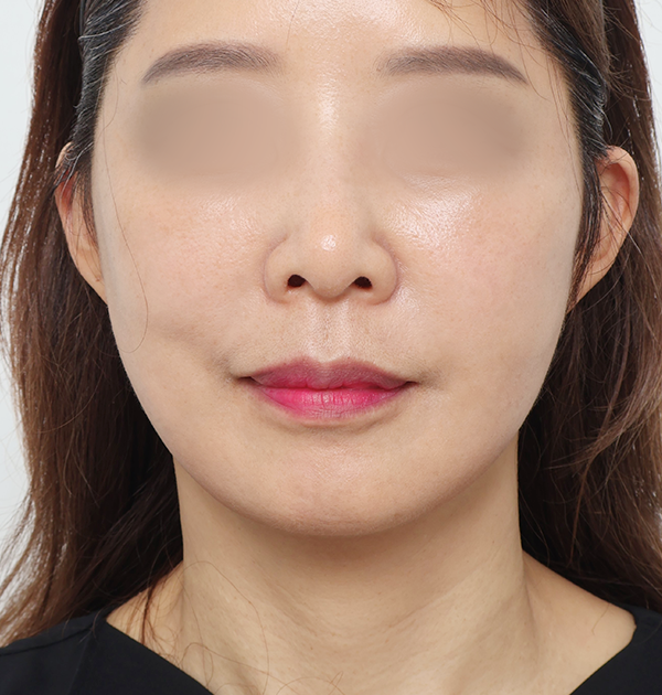 [중하안면 미니거상 + 얼굴지방재배치] 후