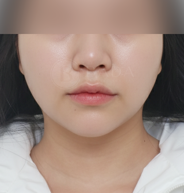 [심부볼제거 + 볼 지방흡입 + 턱끝 필러] 후