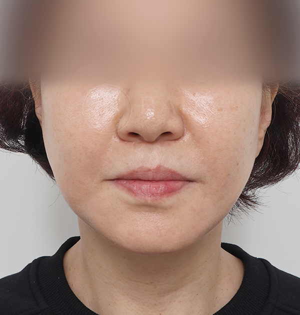 [안면거상 + 목거상] 후