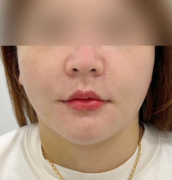[하안면 미니거상 + 심부볼지방재배치] 후