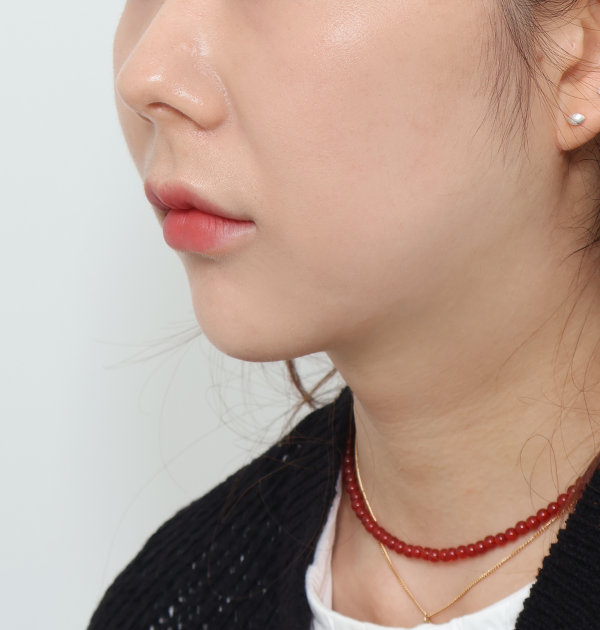 [엘라스티꿈 목리프팅 + 지방흡입(볼, 이중턱) + 턱라인 지방재배치] 후