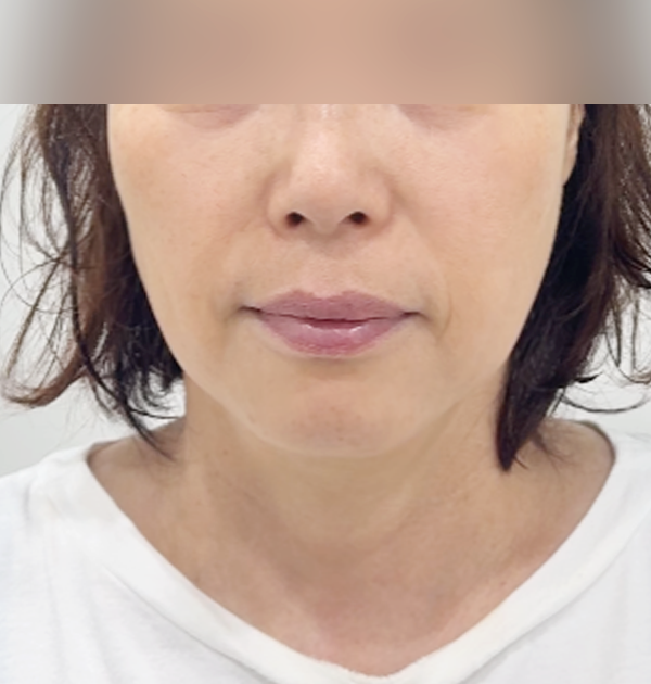 [하안면 미니거상 + 목거상 + 지방이식] 전