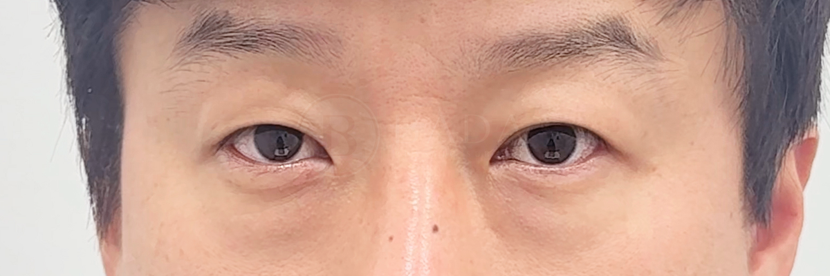 [눈밑지방재배치 + 하안지방이식] 전