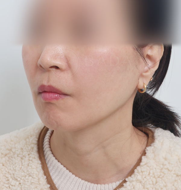 [중하안면 미니거상] 후