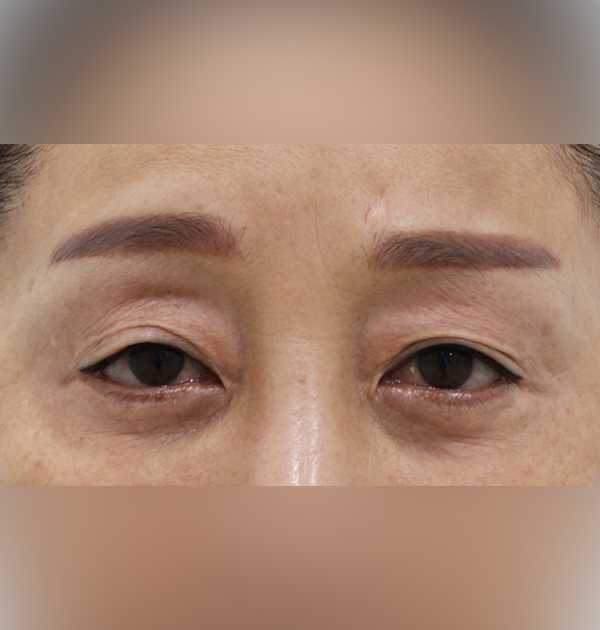 [상안검 재수술 + 눈매교정] 전