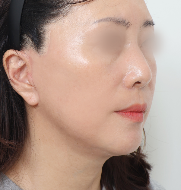 [중하안면 미니거상 + 심부볼지방재배치 + 스킨보톡스] 후