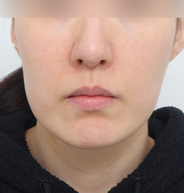 [중하안면 미니거상 + 얼굴지방이식] 전