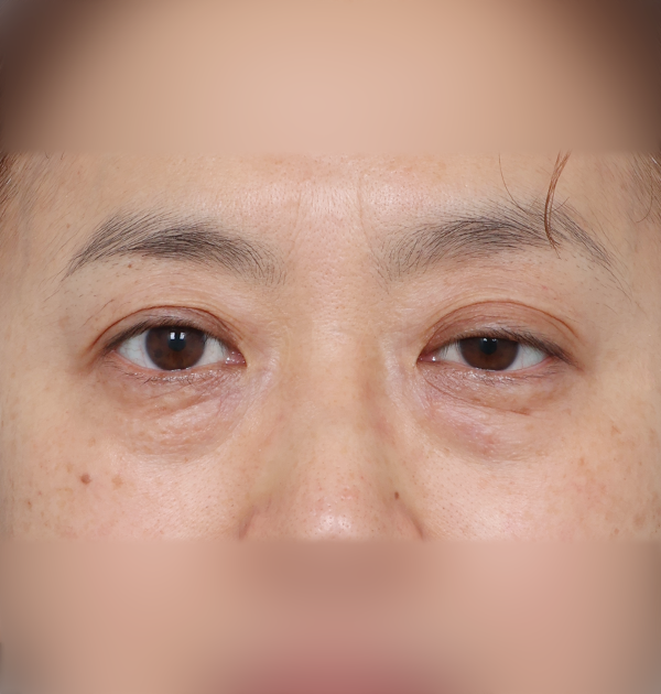 [상안검 눈매교정 + 하안검 지방재배치 + 눈밑미세지방이식] 전