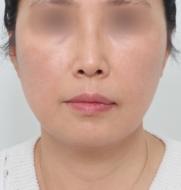 [딥플레인 안면거상 + 목거상] 후