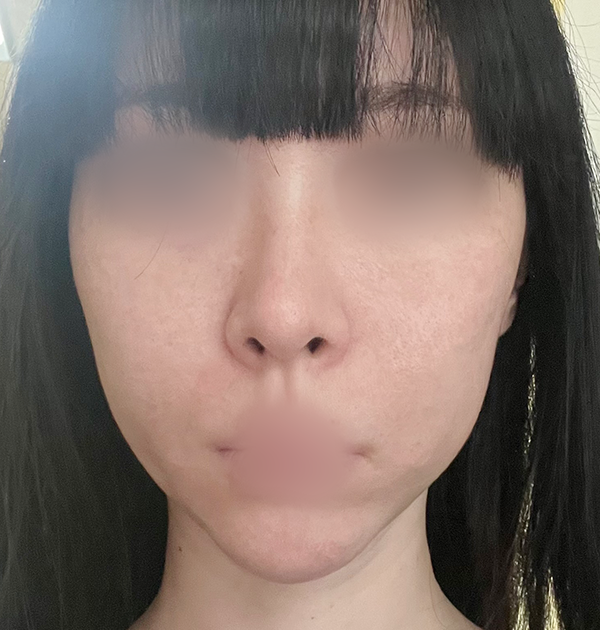 [중안면 미니거상 + 지방흡입(마리오넷, 심술보)] 전