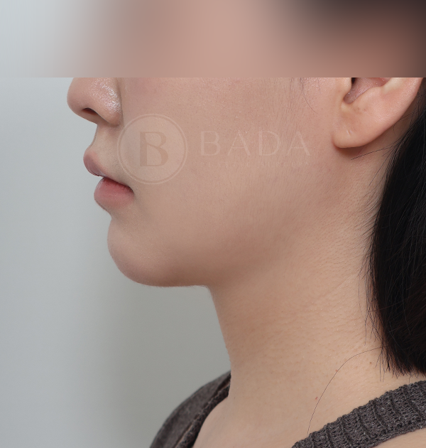 [이중턱근육묶기 + 얼굴지방흡입(이중턱, 심술보) + 심부볼지방제거] 후