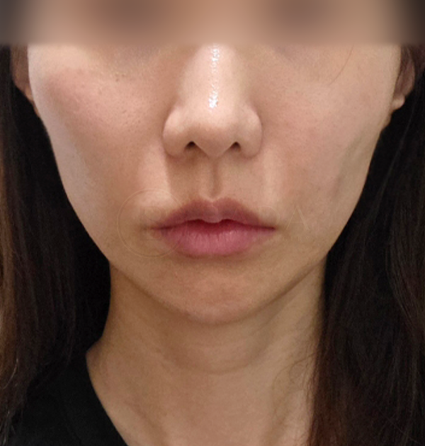 [하안면 미니거상 + 얼굴지방이식(팔자, 옆볼)] 전