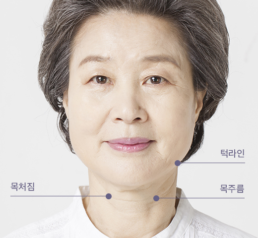 목거상술 수술정보