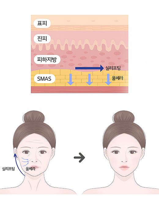 더 넓은 범위를 효과적으로 고정하는 바다만의 기술