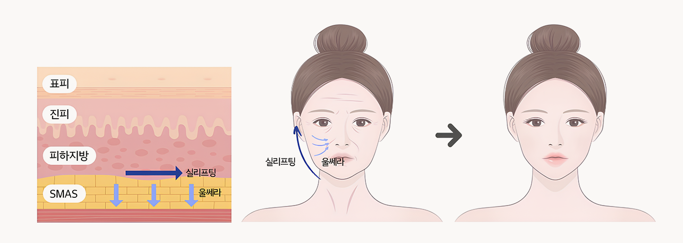 더 넓은 범위를 효과적으로 고정하는 바다만의 기술