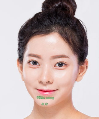 리프팅필러 STEP 3 이미지