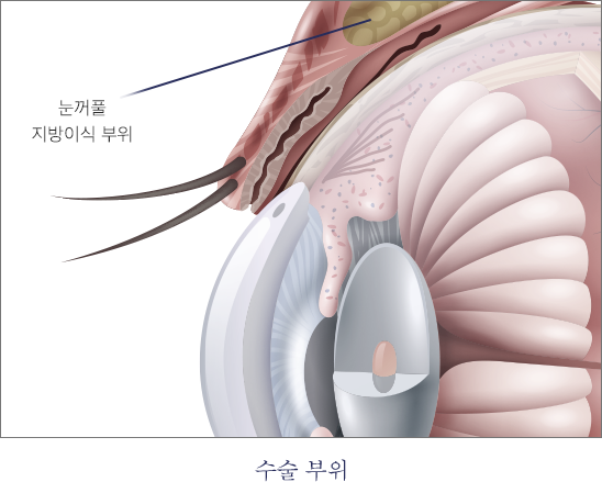 눈 위 지방이식 이미지