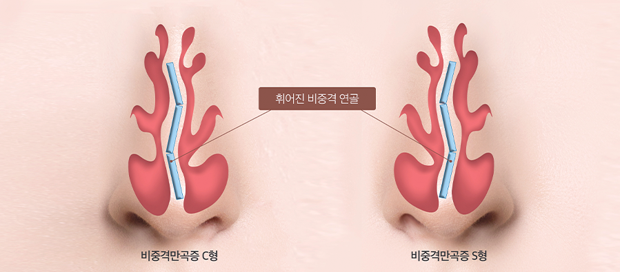 비중격만곡증 이미지