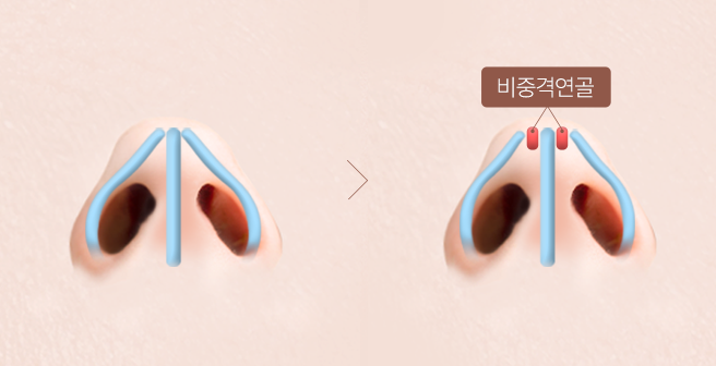 비밸브 협착증 STEP 1 이미지