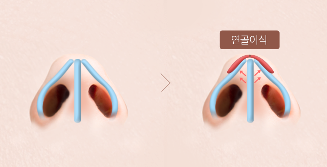 비밸브 협착증 STEP 4 이미지