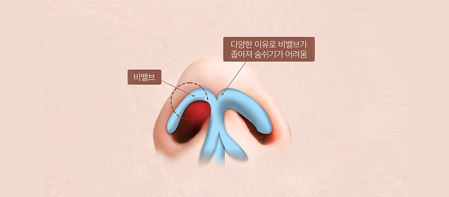 비밸브 협착증 이미지