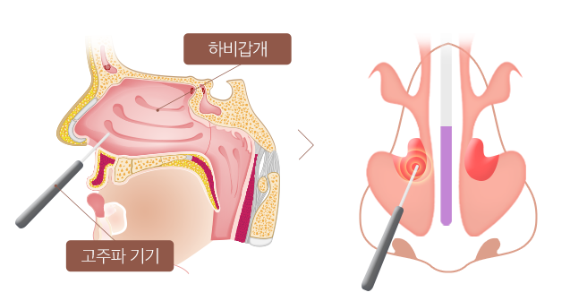 하비갑개 비대증 STEP 1 이미지