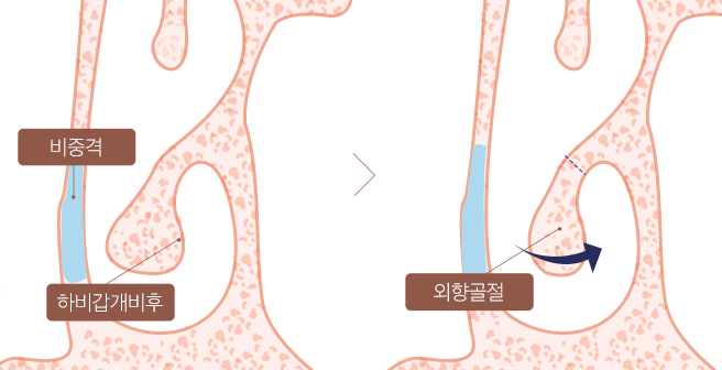 하비갑개 비대증 STEP 4 이미지