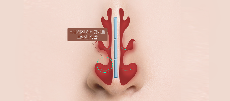 하비갑개 비대증 이미지